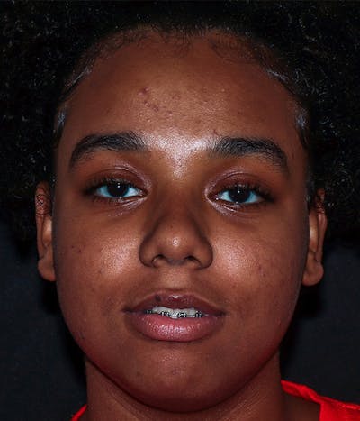 AviClear Before & After Gallery - Patient 274349 - Image 1