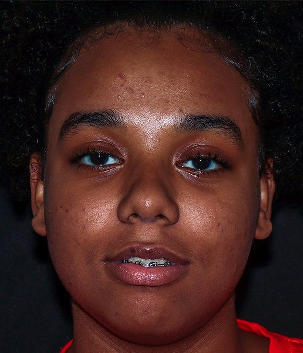 AviClear Before & After Gallery - Patient 274349 - Image 1