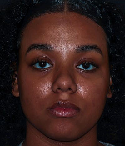 AviClear Before & After Gallery - Patient 274349 - Image 2