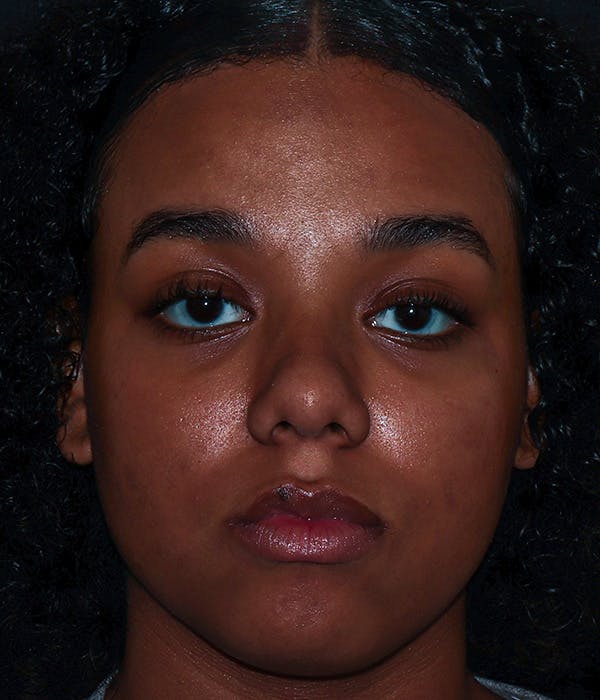AviClear Before & After Gallery - Patient 274349 - Image 2