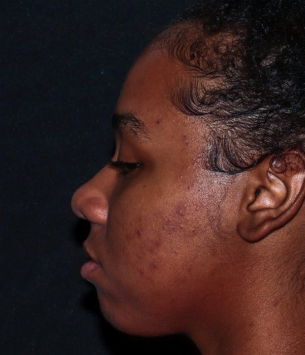 AviClear Before & After Gallery - Patient 274349 - Image 3