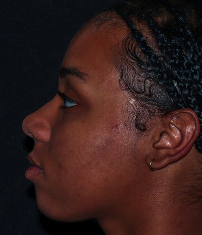 AviClear Before & After Gallery - Patient 274349 - Image 4
