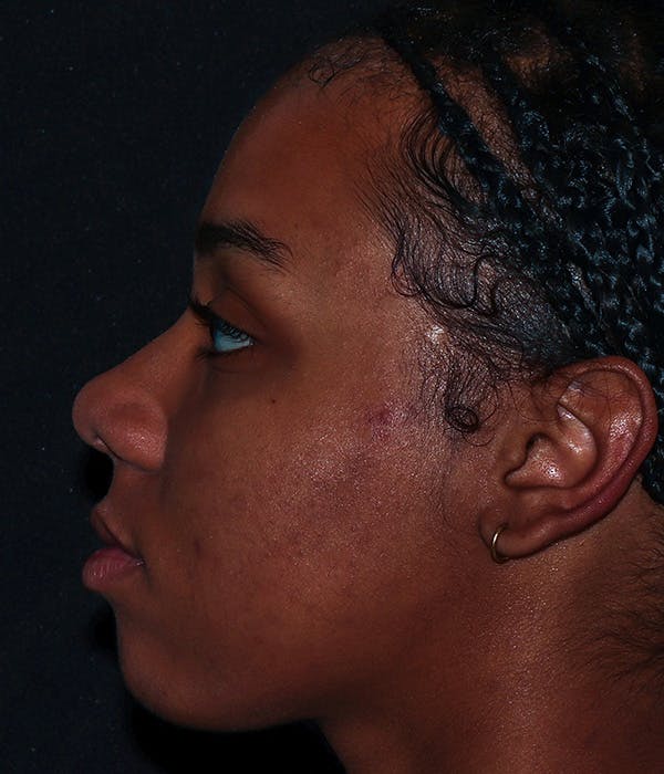 AviClear Before & After Gallery - Patient 274349 - Image 4