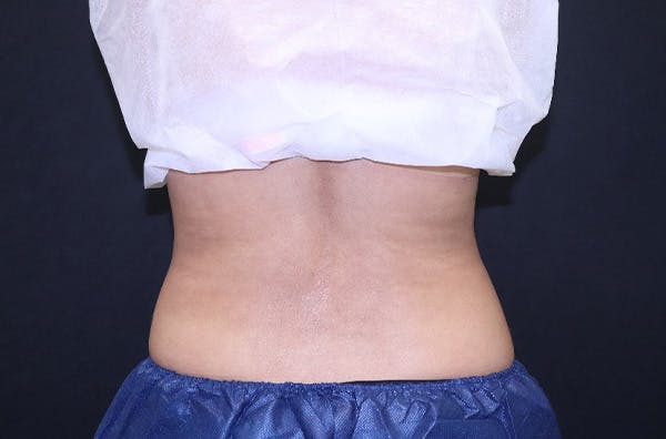 CoolSculpting® Elite Before & After Gallery - Patient 229294 - Image 5
