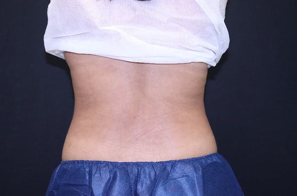 CoolSculpting® Elite Before & After Gallery - Patient 229294 - Image 6