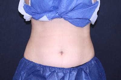 CoolSculpting® Elite Before & After Gallery - Patient 229294 - Image 2
