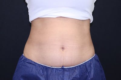 CoolSculpting® Elite Before & After Gallery - Patient 229294 - Image 1