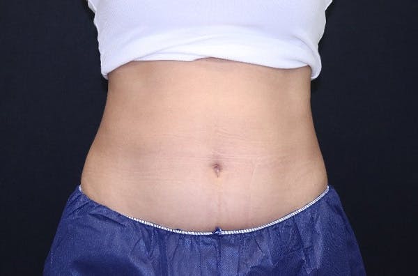 CoolSculpting® Elite Before & After Gallery - Patient 229294 - Image 1