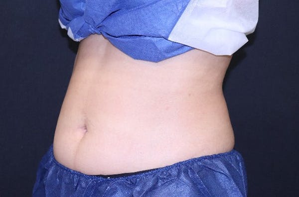 CoolSculpting® Elite Before & After Gallery - Patient 229294 - Image 3