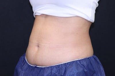 CoolSculpting® Elite Before & After Gallery - Patient 229294 - Image 4