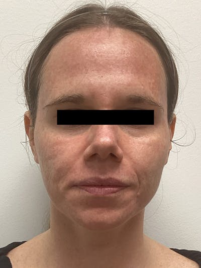 Moxi Laser Before & After Gallery - Patient 263242 - Image 1