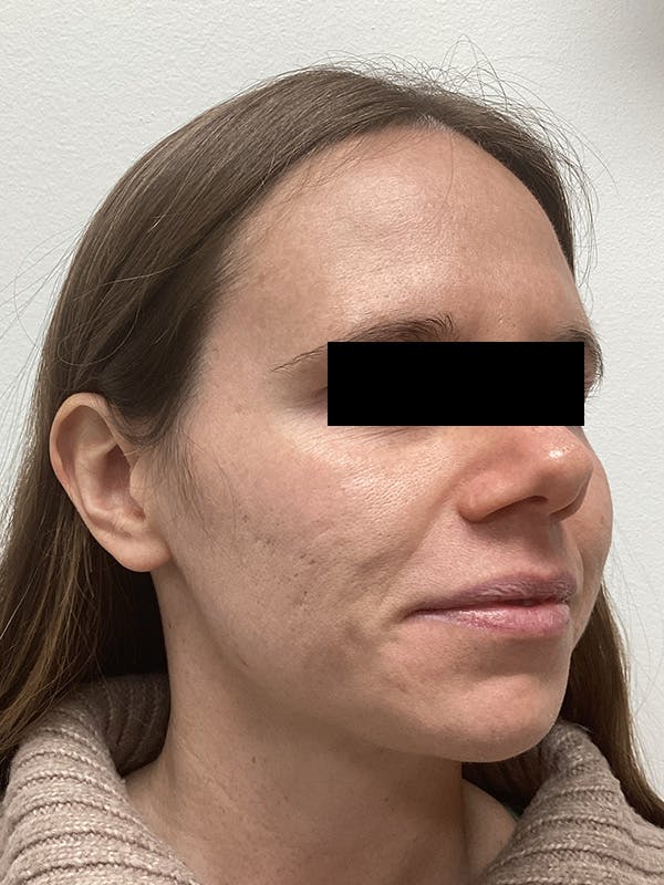 Moxi Laser Before & After Gallery - Patient 263242 - Image 4