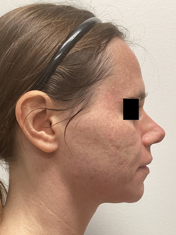 Moxi Laser Before & After Gallery - Patient 263242 - Image 5