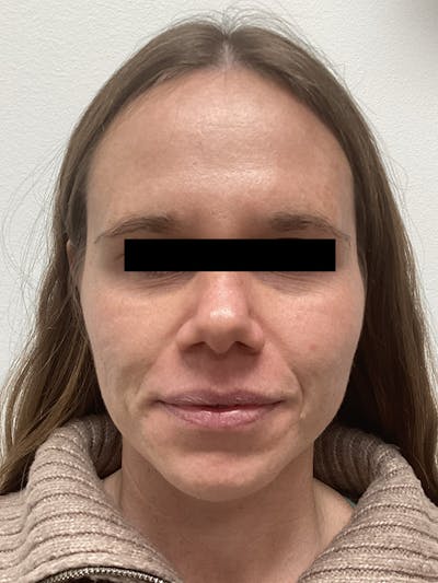 Moxi Laser Before & After Gallery - Patient 263242 - Image 2