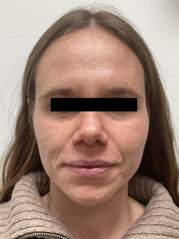 Moxi Laser Before & After Gallery - Patient 263242 - Image 2