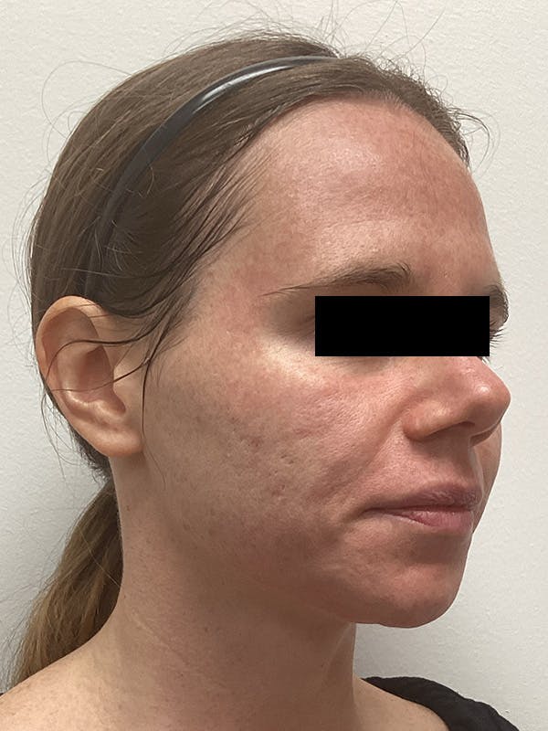 Moxi Laser Before & After Gallery - Patient 263242 - Image 3