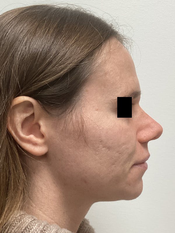 Moxi Laser Before & After Gallery - Patient 263242 - Image 6
