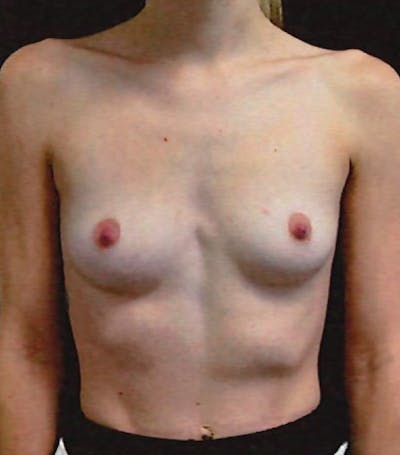 Breast Augmentation Before & After Gallery - Patient 270063 - Image 1
