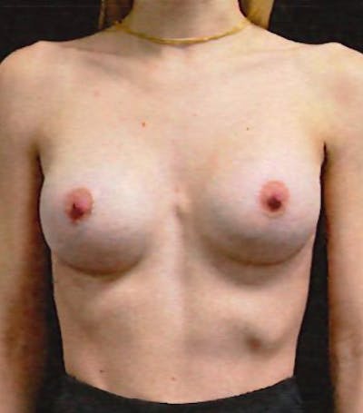 Breast Augmentation Before & After Gallery - Patient 270063 - Image 2