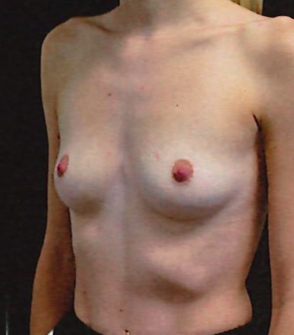 Breast Augmentation Before & After Gallery - Patient 270063 - Image 3