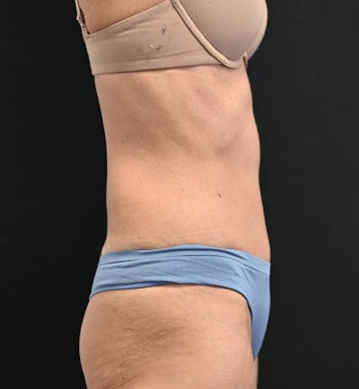 Tummy Tuck Before & After Gallery - Patient 519435 - Image 6