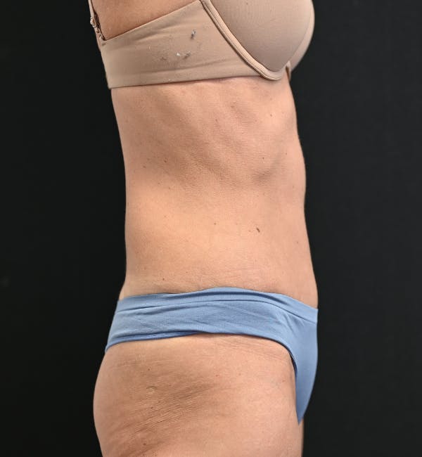 Tummy Tuck Before & After Gallery - Patient 519435 - Image 6