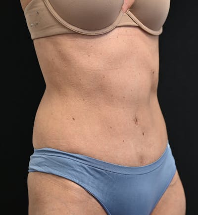 Tummy Tuck Before & After Gallery - Patient 519435 - Image 4