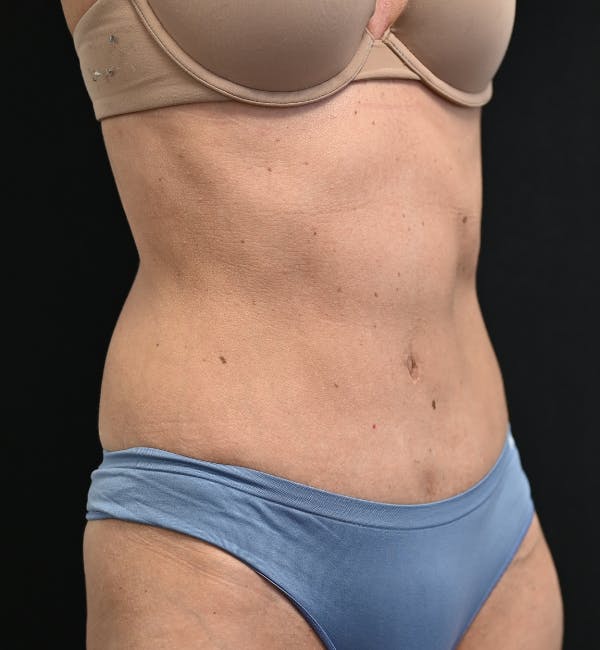 Tummy Tuck Before & After Gallery - Patient 519435 - Image 4