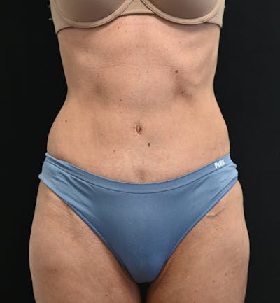 Tummy Tuck Before & After Gallery - Patient 519435 - Image 2