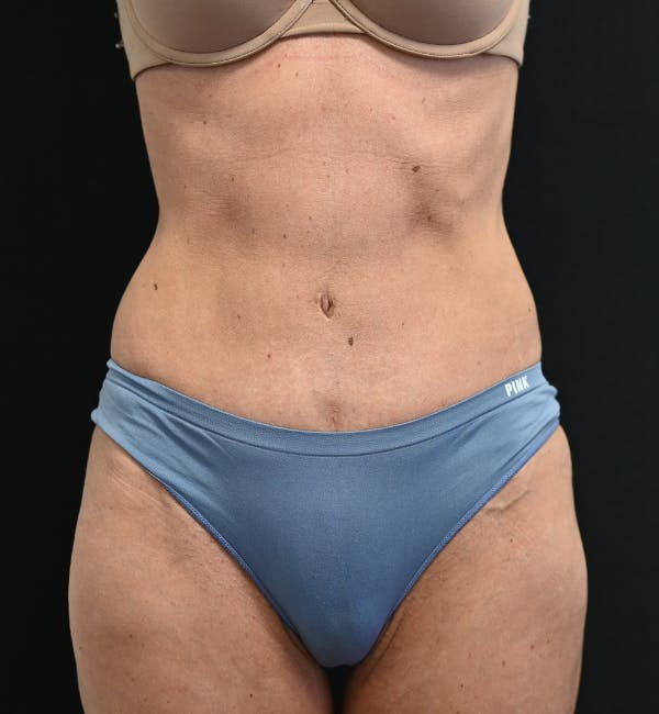 Tummy Tuck Before & After Gallery - Patient 519435 - Image 2