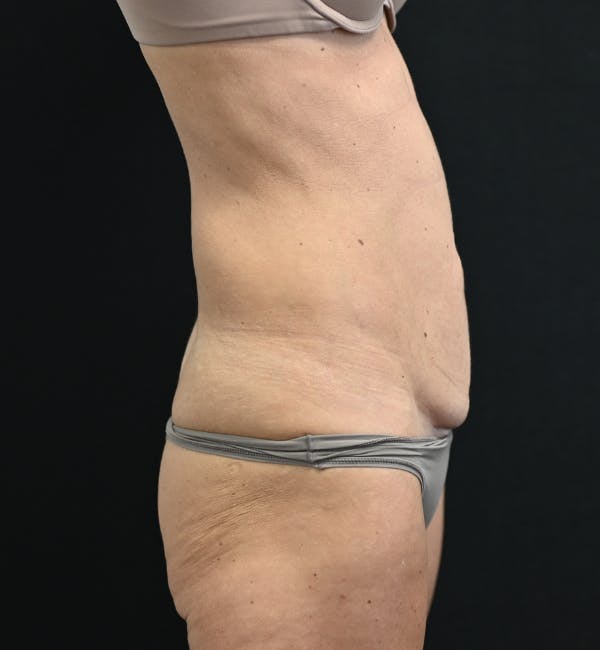Tummy Tuck Before & After Gallery - Patient 519435 - Image 5