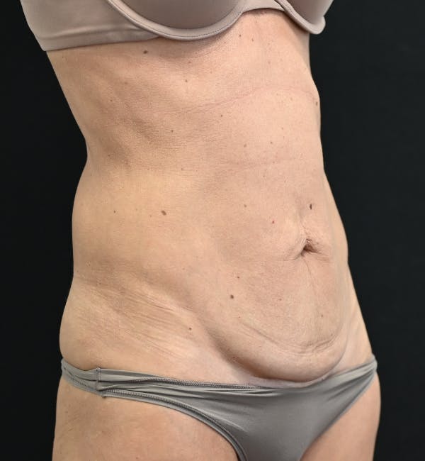 Tummy Tuck Before & After Gallery - Patient 519435 - Image 3