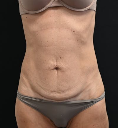Tummy Tuck Before & After Gallery - Patient 519435 - Image 1