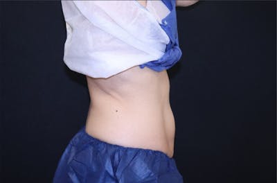 CoolSculpting® Elite Before & After Gallery - Patient 283955 - Image 4