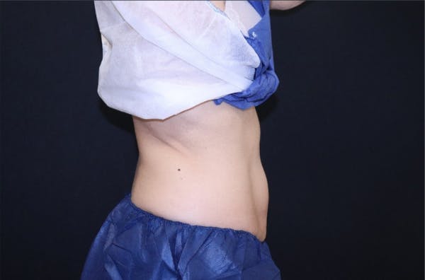 CoolSculpting® Elite Before & After Gallery - Patient 283955 - Image 4