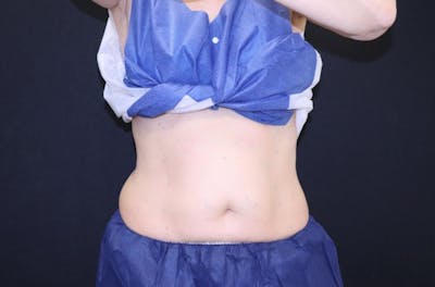 CoolSculpting® Elite Before & After Gallery - Patient 283955 - Image 1