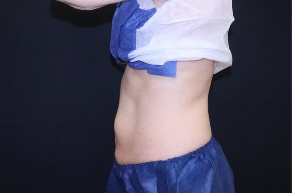 CoolSculpting® Elite Before & After Gallery - Patient 283955 - Image 6