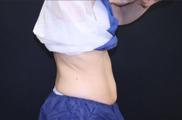 CoolSculpting® Elite Before & After Gallery - Patient 283955 - Image 3
