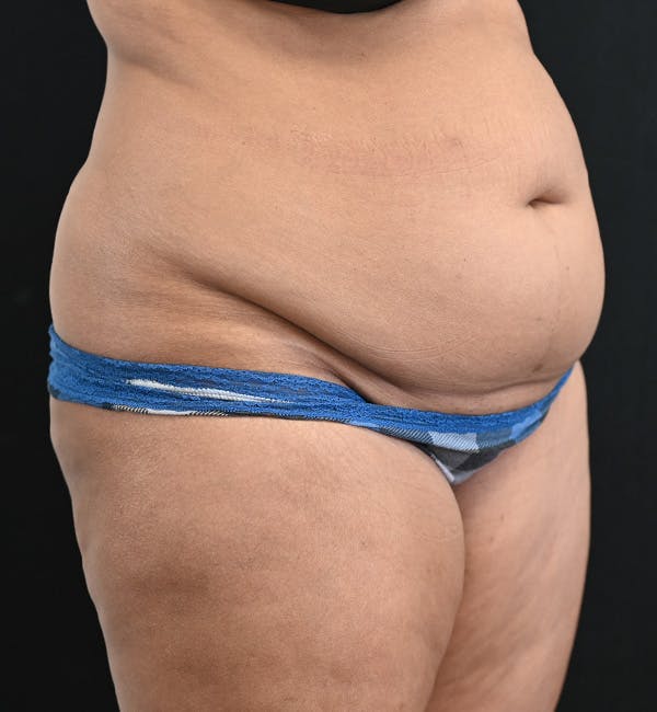 Female Liposuction Before & After Gallery - Patient 301386 - Image 3