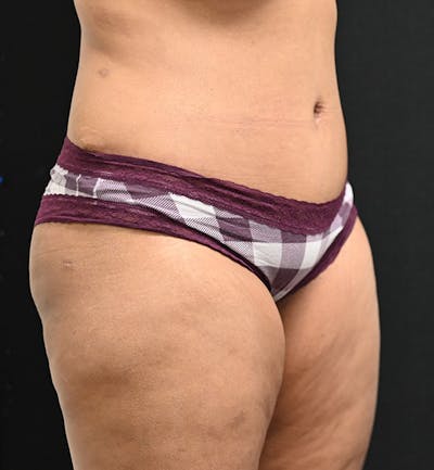 Female Liposuction Before & After Gallery - Patient 301386 - Image 4