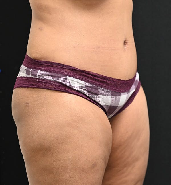 Female Liposuction Before & After Gallery - Patient 301386 - Image 4