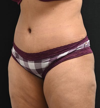 Female Liposuction Before & After Gallery - Patient 301386 - Image 6
