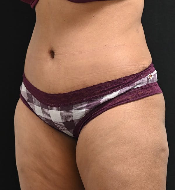 Female Liposuction Before & After Gallery - Patient 301386 - Image 6