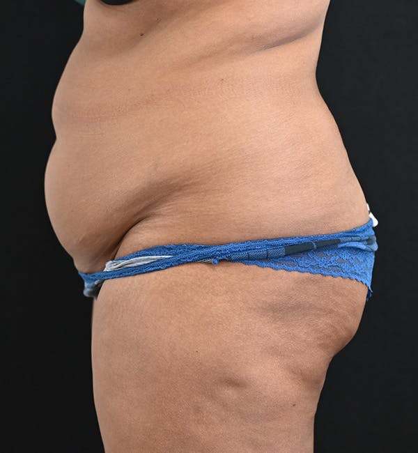 Female Liposuction Before & After Gallery - Patient 301386 - Image 7