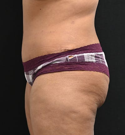 Female Liposuction Before & After Gallery - Patient 301386 - Image 8
