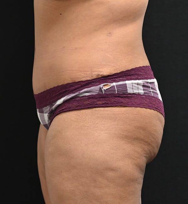 Female Liposuction Before & After Gallery - Patient 301386 - Image 8