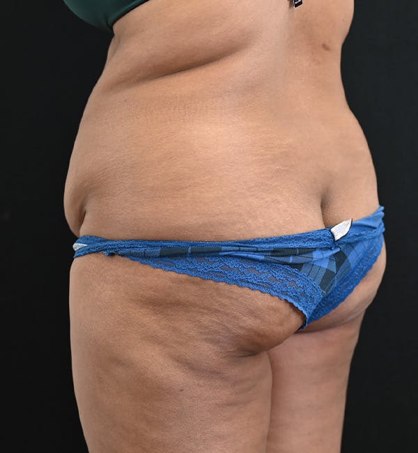 Female Liposuction Before & After Gallery - Patient 301386 - Image 13