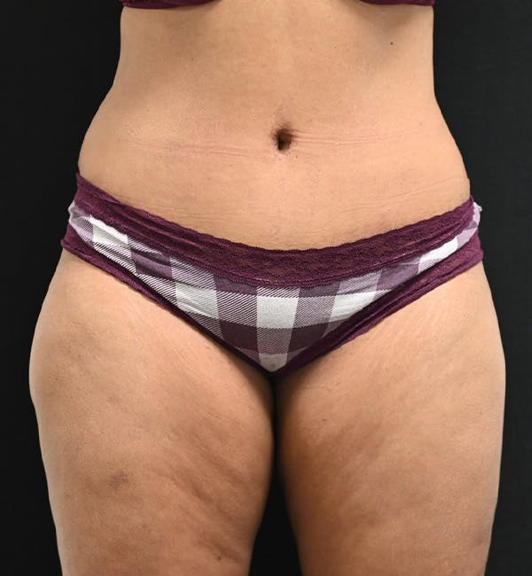Female Liposuction Before & After Gallery - Patient 301386 - Image 2