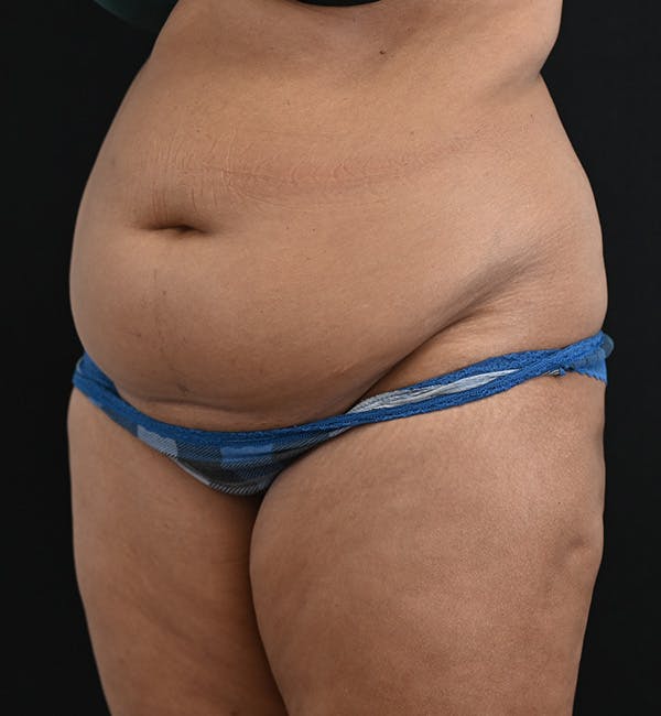 Female Liposuction Before & After Gallery - Patient 301386 - Image 5