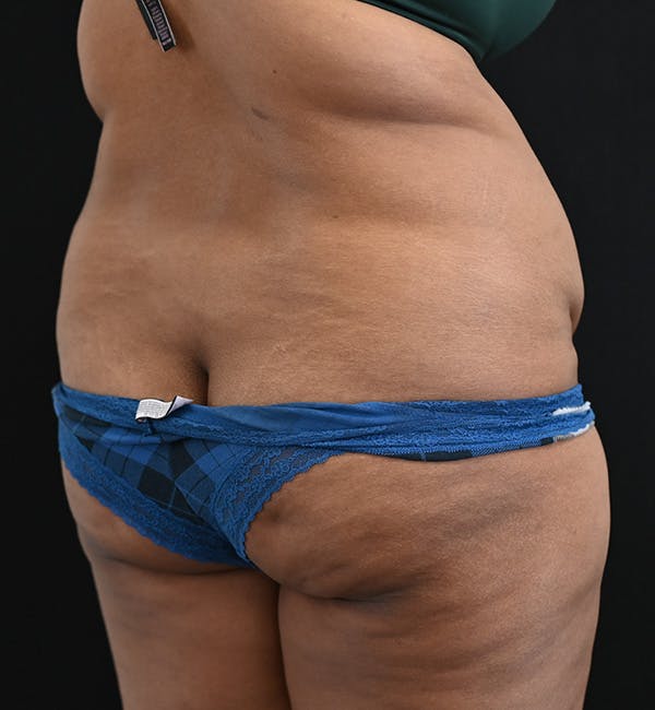 Female Liposuction Before & After Gallery - Patient 301386 - Image 9